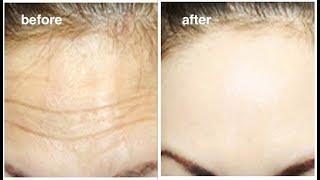 1 Smart trick to Rapidly Remove Wrinkles & Fine lines on Forehead In 2 Days