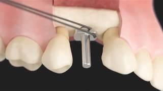 SEVIL SMILE STUDIO - Astra Tech Implant System