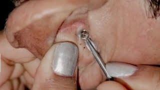 Best Ear Blackhead Extraction | Ear Blackhead | Big Blackhead #pimple