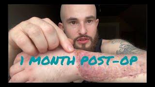 1 Month Post Op - Stage 1 Phalloplasty