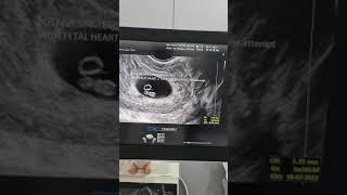 IVF pregnancy. S40