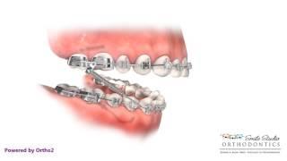 Forsus - Orthodontic Appliance