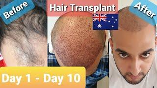 Day 1 - Day 10 | FUE 1800 Graft | Daily Update | Hair Transplant Sydney | Australia |