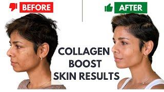 6 Non invasive ways to boost collagen in your skin