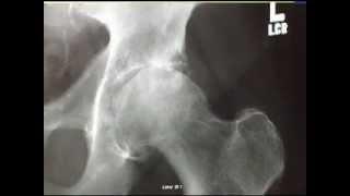 Diagnosing an Arthritic Hip Joint