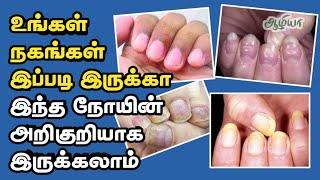 நகங்கள் காட்டும் 10 நோயின் அறிகுறிகள்|Your Nails Reflects Your Health | Aazhiya  Health
