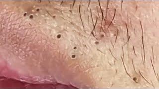 BEAUTY OF SQUEEZE BLACKHEADS REMOVAL FROM THE LIPS #3  #relaxing  #blackheads