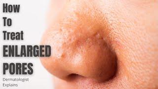 Enlarged Pores | How to effectively treat