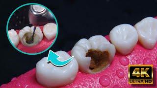 Невероятная реконструкция зуба, поврежденного кариесом: эндодонтия в 4K