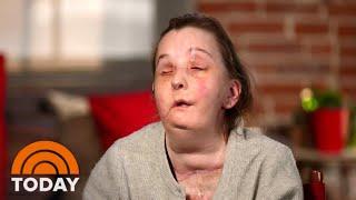 Woman Who Received Face Transplant Meets Donor’s Family | TODAY