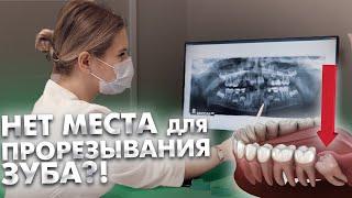 Что делать, если у ребенка дефицит места в зубном ряду для прорезывания постоянных зубов?