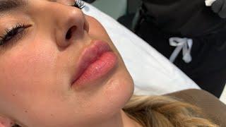 GET THOSE JUICY RUSSIAN LIPS WITH NO DOWNTIME FILLER INJECTIONS | Hollywood, CA | Dr. Jason Emer