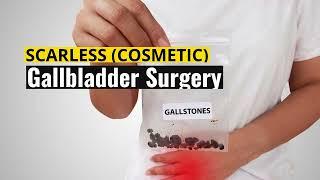 Scarless Cosmetic Gallbladder Surgery | Single Incision Laparoscopic Surgery | SILS #gallbladder