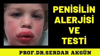 Penisilin Alerjisi, Belirtileri,Prof.Dr.Serdar Akgün,Sağlık,Sağlık Haberleri,Sağlıklı Yaşam