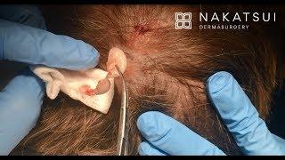 Cyst removal