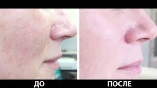 Лечение купероза и капилляров на лице ультрасовременным лазером в Центре Флебологии