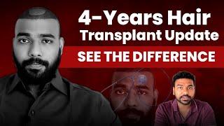 4 years Hair transplant results and what I followed for better results