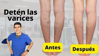 Ejercicios para ayudar a mejorar la circulación y prevenir las varices