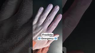 Frostbite? Try this… #medical #health #survival