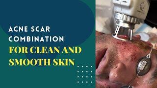 ACNE SCAR COMBINATION FOR CLEAN AND SMOOTH SKIN | Dr. Jason Emer