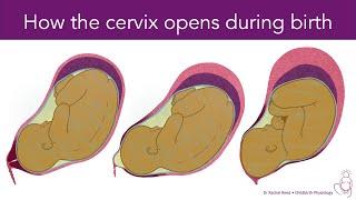 Transformation of the Uterus During Labour