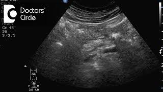 Are the EUS/ERCP painful? Do they cause Pancreatitis? - Dr. Vidyasagar Ramappa