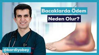 Bacaklarda Ödem Neden Olur? Bacak Ödemi Tehlikeli midir?