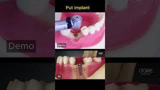 How is dental implant?