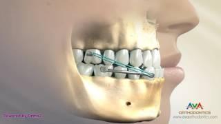 Orthodontic Treatment for Underbite or Crossbite - Carriere Appliance