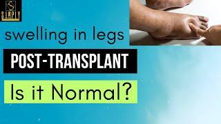 Swelling in Legs Post-transplant- How to reduce swelling in feet? Personal Experience