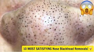 Top 10 Deep Nose Blackhead Extractions – So Satisfying to Watch! 