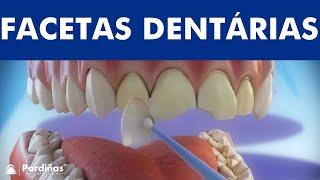 Facetas dentárias - Preparação e colocação de facetas ©