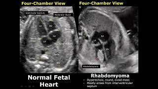 Fetal Chest Ultrasound Normal Vs Abnormal Image Appearances | Echocardiography | Heart & Lungs USG