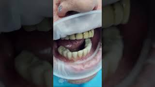 Планируем удалить 8 зубов и поставить 6 имплантатов и временные зубы. Имплантация зубов.