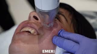 COVID CAUSED ACNE AND SCARS WHICH WERE SOFTENED WITH PIXEL, HALO, BELLAFILL & EMER SKIN | Dr. Emer
