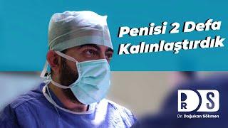 Penis Kalınlaştırma Ameliyatı | HardRock Sandviç İle Penis Kalınlaştırma - Dr. Doğukan Sökmen