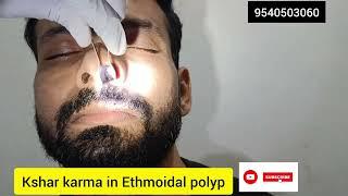 Ethmoidal polyp kshar removal....