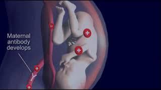 Jaundice: Hemolytic Disease "Erythroblastosis fetalis" in Newborn