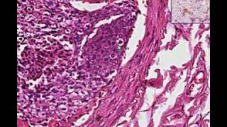 Histopathology Lung --Tumor emboli