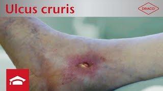 Ulcus cruris venosum und arteriosum: Definition, Entstehung & Wundbeschreibung