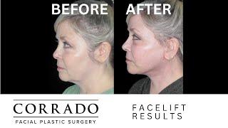 AMAZING Facelift Transformation: Before and After Photos | Dr. Anthony Corrado