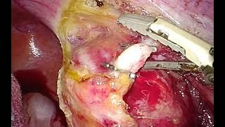 Laparoscopic dissection of a lateral pelvic Schwannoma