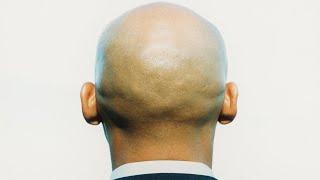 ‘Hair-wrenchingly ridiculous’: Judges rule mocking baldness is sexual harassment