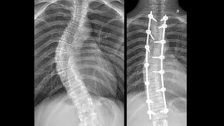 Коррекция сколиоза 3 степени | Отзыв после операции