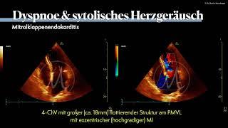 〖Echokardiografie〗 Dyspnoe & ein Systolikum - Mitralklappenendokarditis 🫀