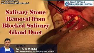 Salivary Stone Removal from Blocked Salivary Gland Duct