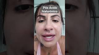 Pós Ácido hialurónico! Cómo fica? #acidohialuronico #esteticafacial