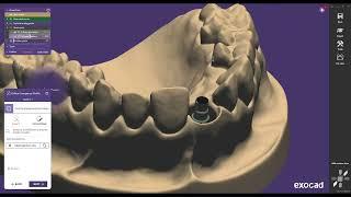 Exocad Elefsina 3.2 (2024): New ASC Flex Features & Angled Screw Channel Tutorial