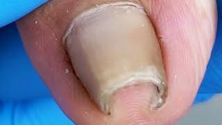 Amazing! Ingrown nails extremely curly【Xue Yidao】