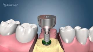 Dental Implant Procedure - Two Stage    Award Winning Patient Education